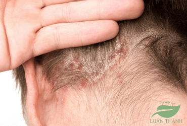 Bệnh vảy nến da đầu: Dấu hiệu nhận biết và cách điều trị