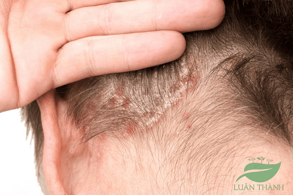 Bệnh vảy nến da đầu: Triệu chứng và cách điều trị