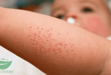 Bé bị mẩn ngứa như muỗi đốt: Nguyên nhân và hướng điều trị