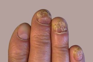 Những cách chữa vẩy nến móng tay hiệu quả nhất hiện nay