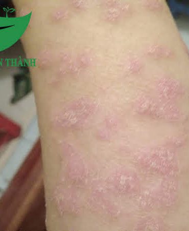 Chị Hà (Cầu Giấy, Hà Nội) Vảy nến – Eczema