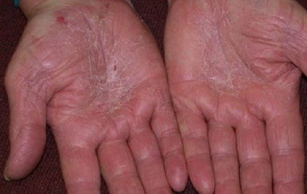 Bệnh á sừng, một trong các bệnh về da thường gặp