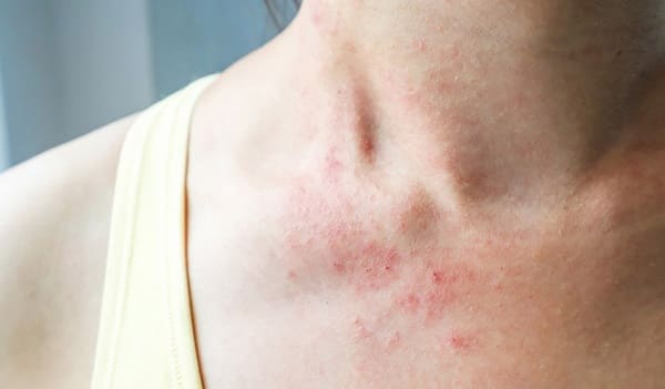 Hình ảnh bệnh chàm (Eczema)