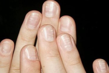 Bệnh vảy nến móng tay, nguyên nhân và cách điều trị