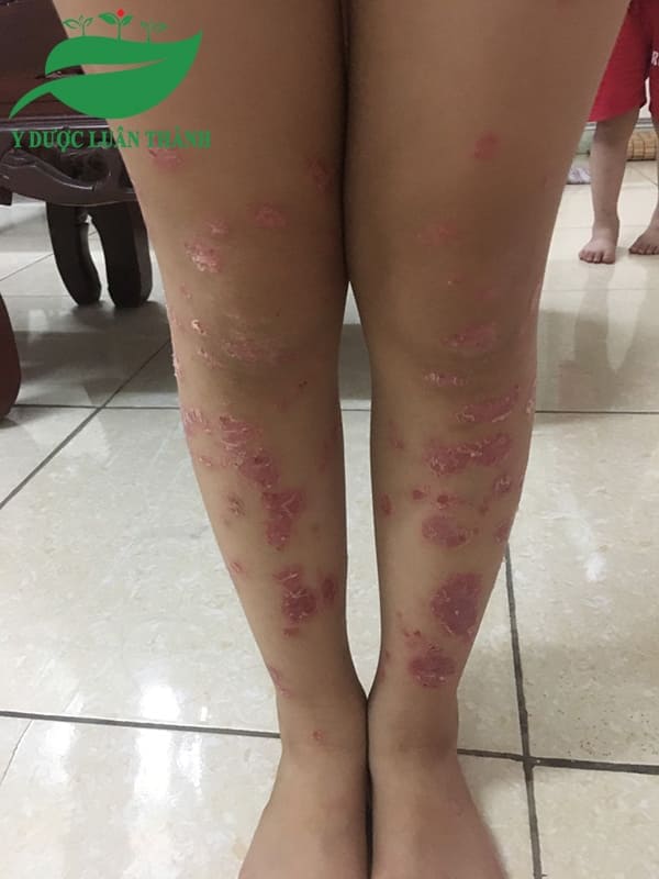 Những vùng da tổn thương tại chân khi chưa sử dụng sản phẩm