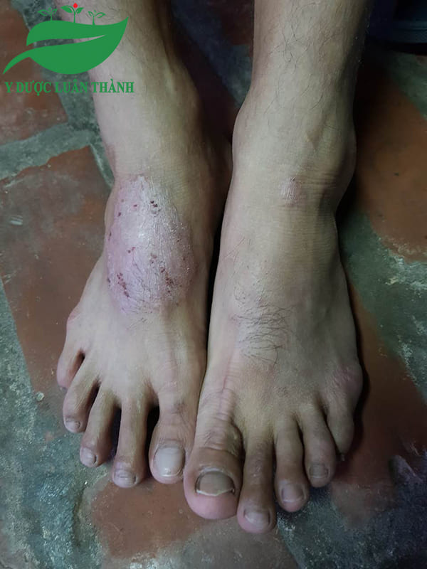 Vùng da chân khi chưa sử dụng sản phẩm