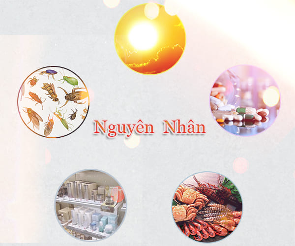 Những nguyên nhân phổ biến dẫn đến bệnh mề đay