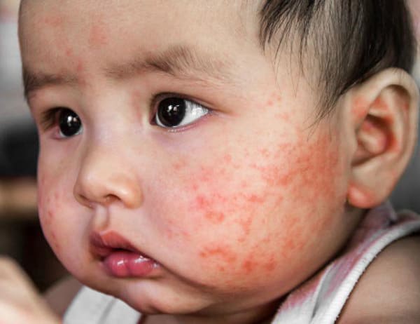 Trẻ nhỏ với hệ miễn dịch yếu ớt dễ dàng là con mồi cho các tác nhân gây viêm da cơ địa