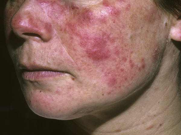 Lupus ban đỏ là 1 bệnh lý rất nguy hiểm có thể gây ra bởi sự rối loạn cân bằng tế bào Lympho T