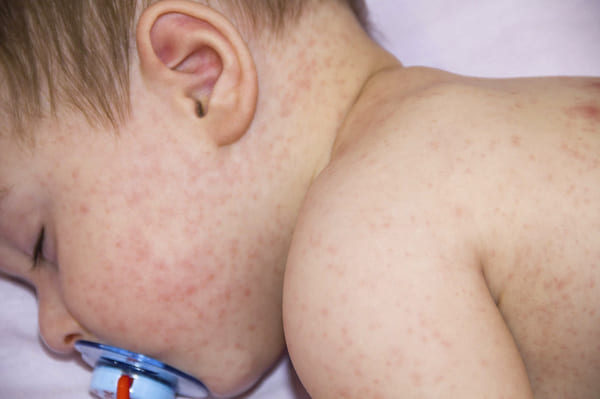Bệnh chàm da ở trẻ sơ sinh đang ngày càng phổ biến