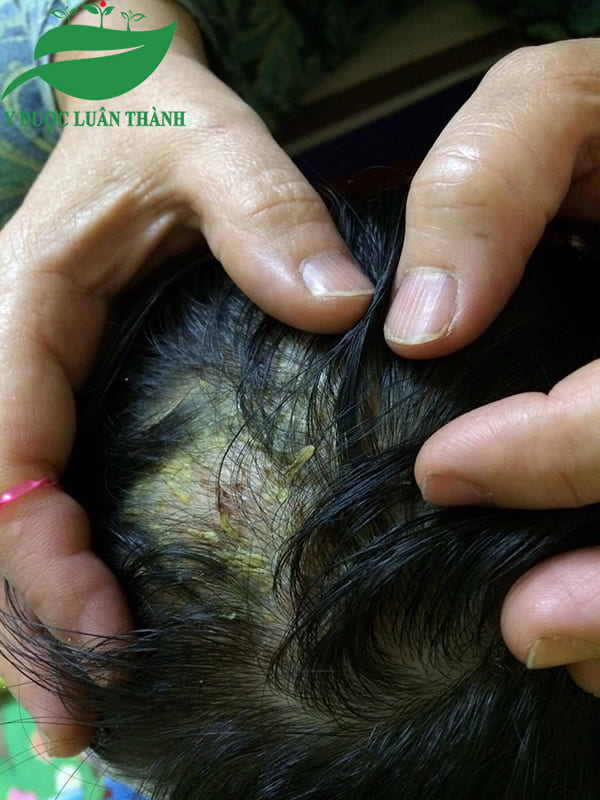 Những mảng bong tróc trên da đầu khi chưa dùng sản phẩm