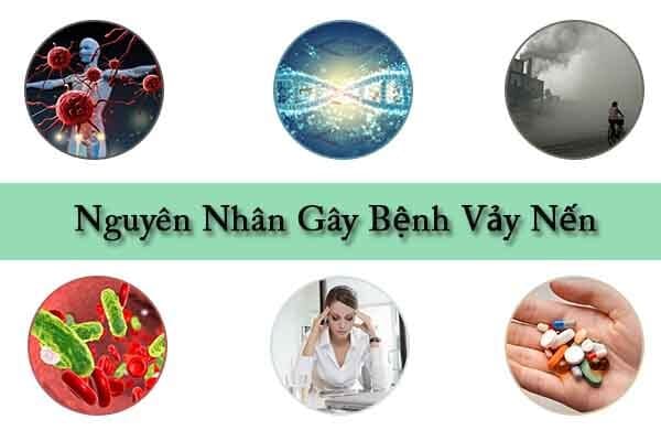 Nguyên nhân gây nên bệnh vảy nến