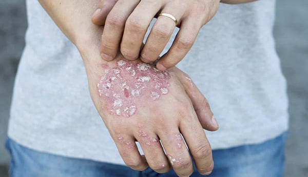 Biểu hiện của bệnh eczema thường rất dễ nhầm lẫn với những bệnh ngoài da khác