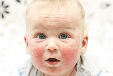 Chàm mặt ở trẻ sơ sinh, nguyên nhân và cách điều trị