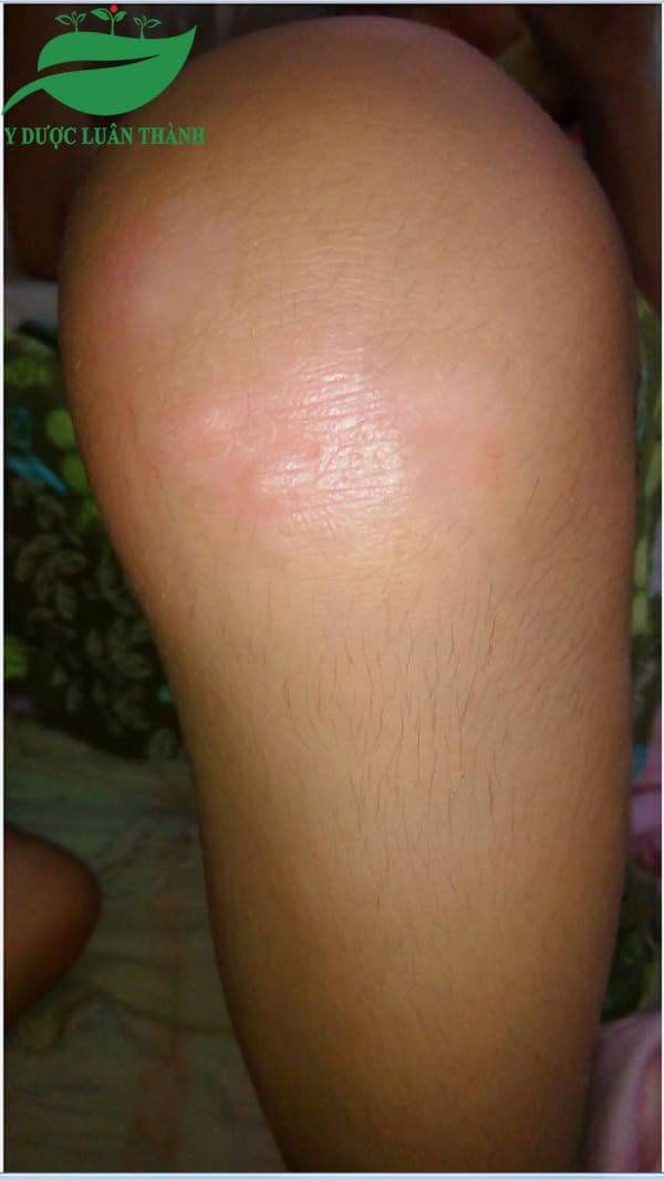 Cải thiện trên da chân sau 3 tháng sử dụng sản phẩm