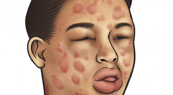Mề đay có thể gây ra tình trạng phù mạch, sưng phồng ở 1 số vùng da