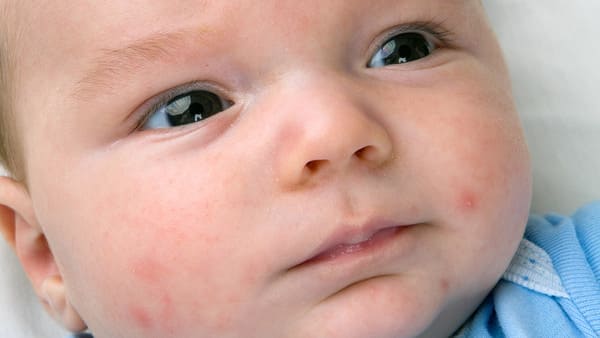 Bệnh chàm ở trẻ nhỏ thường xuất hiện trên mặt