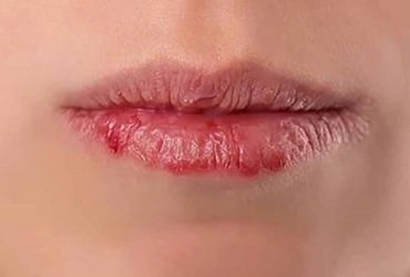Bệnh chàm môi là gì? Cách điều trị và những lưu ý về chế độ ăn uống 