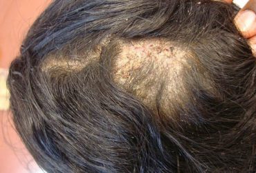 Bệnh nấm da đầu và những kiến thức liên quan