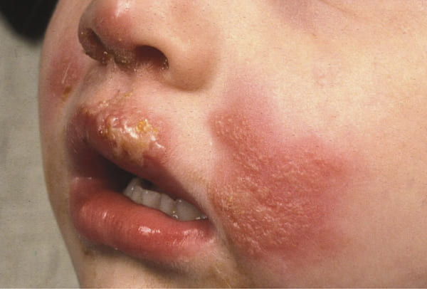 Chàm bội nhiễm ở trẻ nhỏ chủ yếu xuất hiện trên vùng mặt