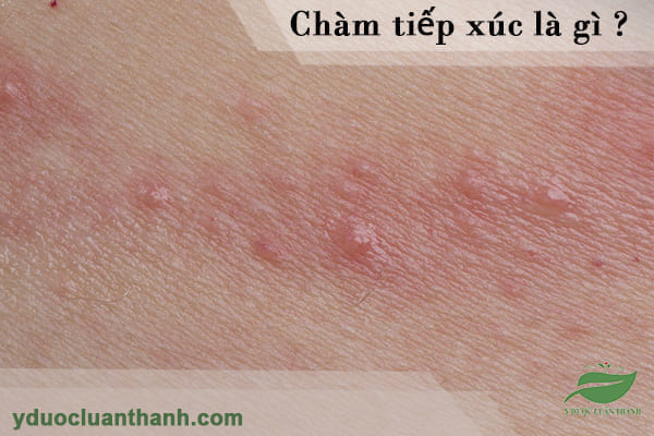 Chàm tiếp xúc là gì?