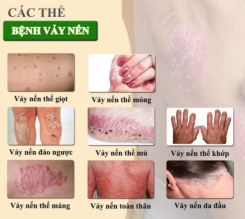 Mỗi thể vảy nến có những triệu chứng khác nhau Mỗi thể vảy nến có những triệu chứng khác nhau