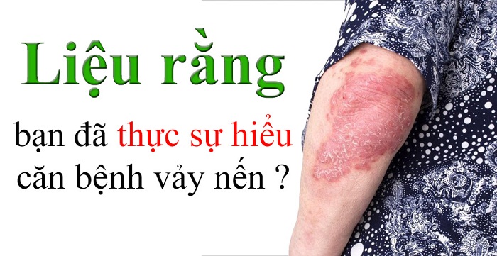 Bạn đã hiểu hết về căn bệnh vảy nến này chưa? Bạn đã hiểu hết về căn bệnh vảy nến này chưa?