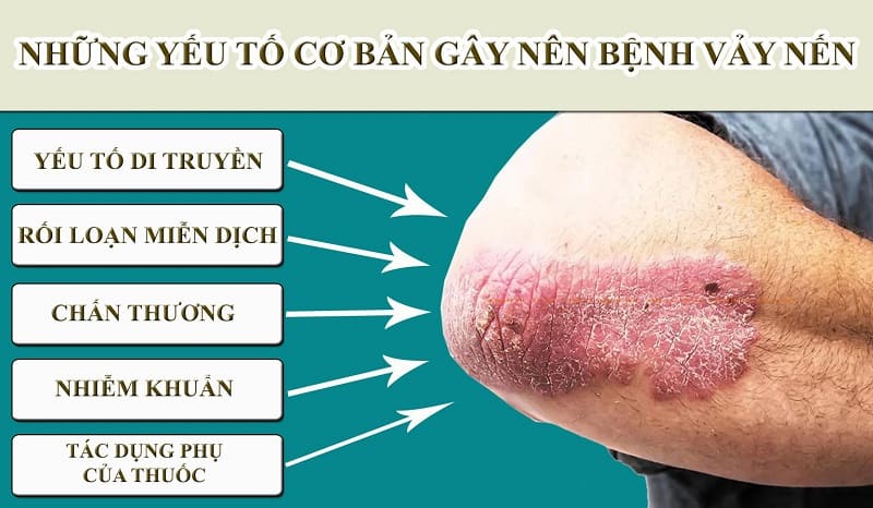 Những nguyên nhân gây nên bệnh vảy nến Những nguyên nhân gây nên bệnh vảy nến