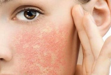 Viêm da tiếp xúc ở mặt – Dấu hiệu và cách điều trị