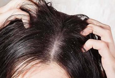 Bệnh á sừng da đầu: Nguyên nhân, triệu chứng và cách điều trị bệnh hiệu quả
