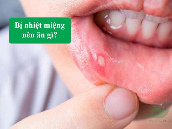 Bị nhiệt miệng nên ăn gì để nhanh khỏi bệnh?