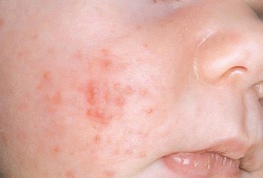 Nguyên nhân trẻ bị nổi nốt đỏ như muỗi đốt và cách điều trị