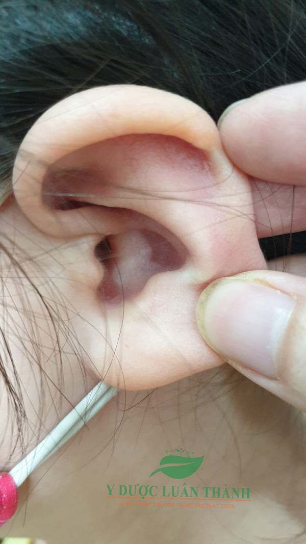 Sau hơn 2 tháng sử dụng sản phẩm, các vùng vảy trên đầu và quanh tai đã mờ dần và biến mất