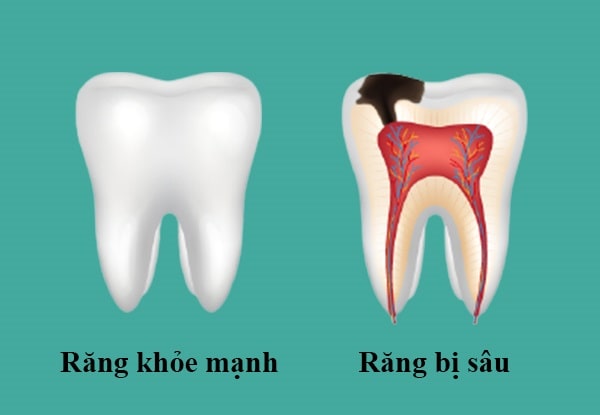 Răng bị sâu gây sưng lợi chảy máu chân răng