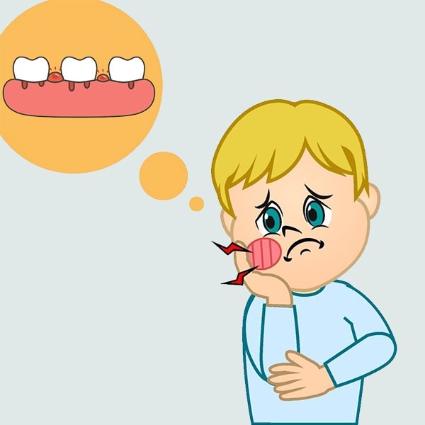 Sưng lợi chảy máu chân răng